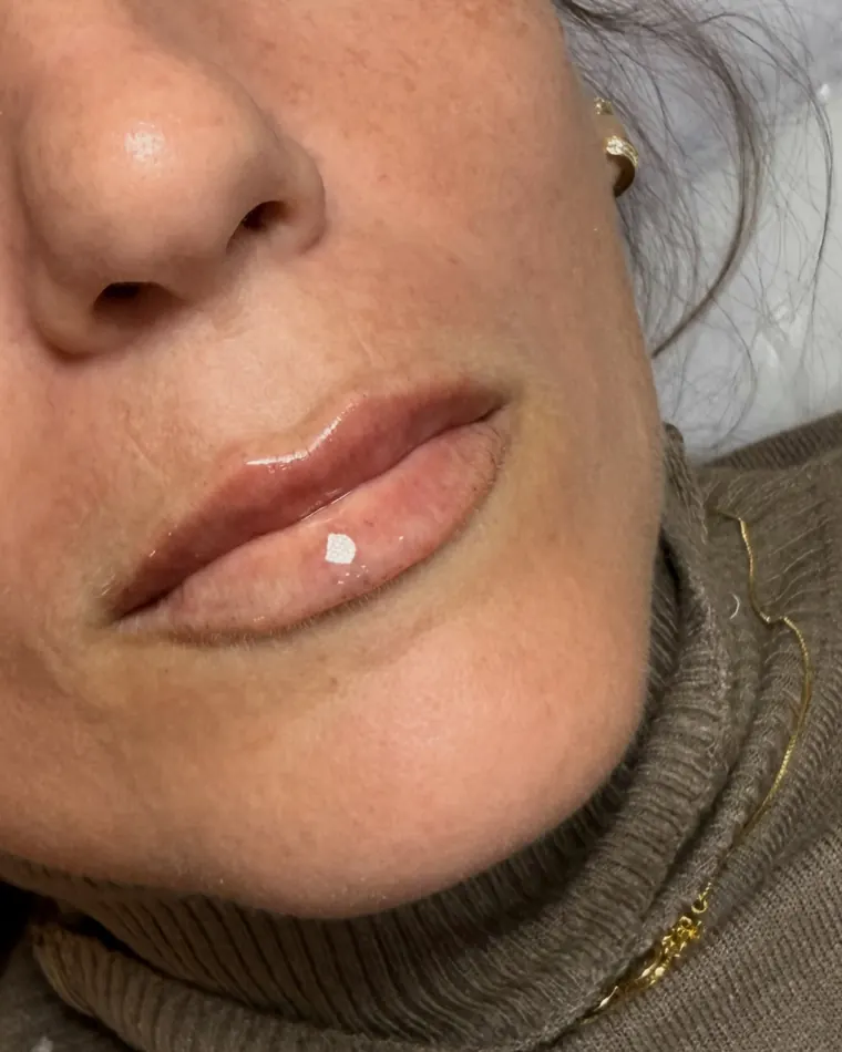 1 ml sem bocão: depois do procedimento