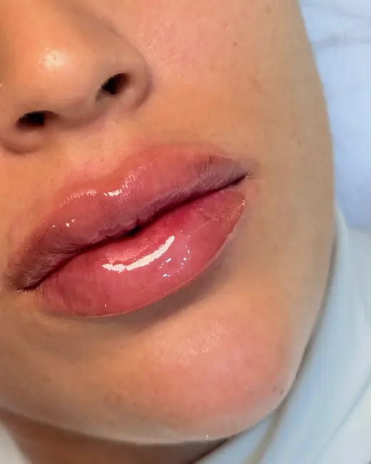Resultado de preenchimento labial RC Lips