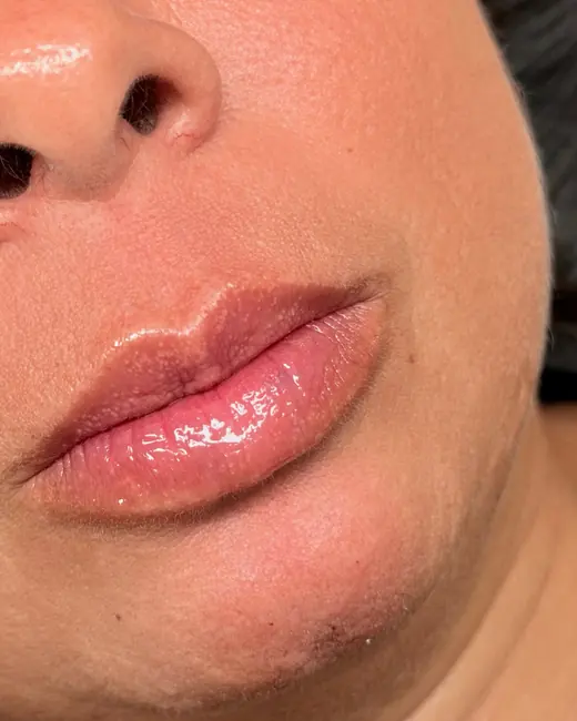Resultado de preenchimento labial RC Lips