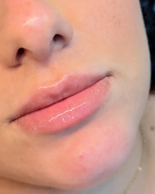 Resultado de preenchimento labial RC Lips