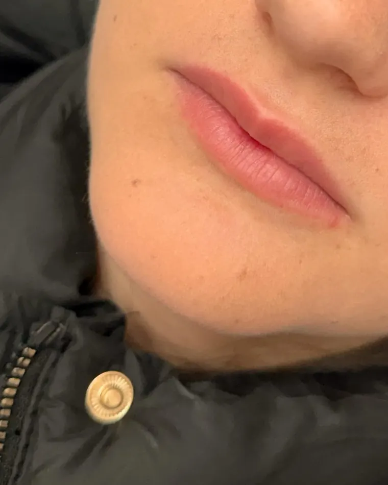 Delicadeza do RC Lips: antes do procedimento