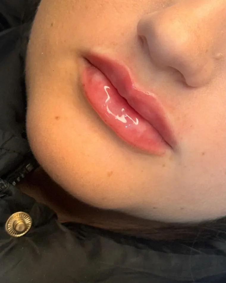 Delicadeza do RC Lips: depois do procedimento