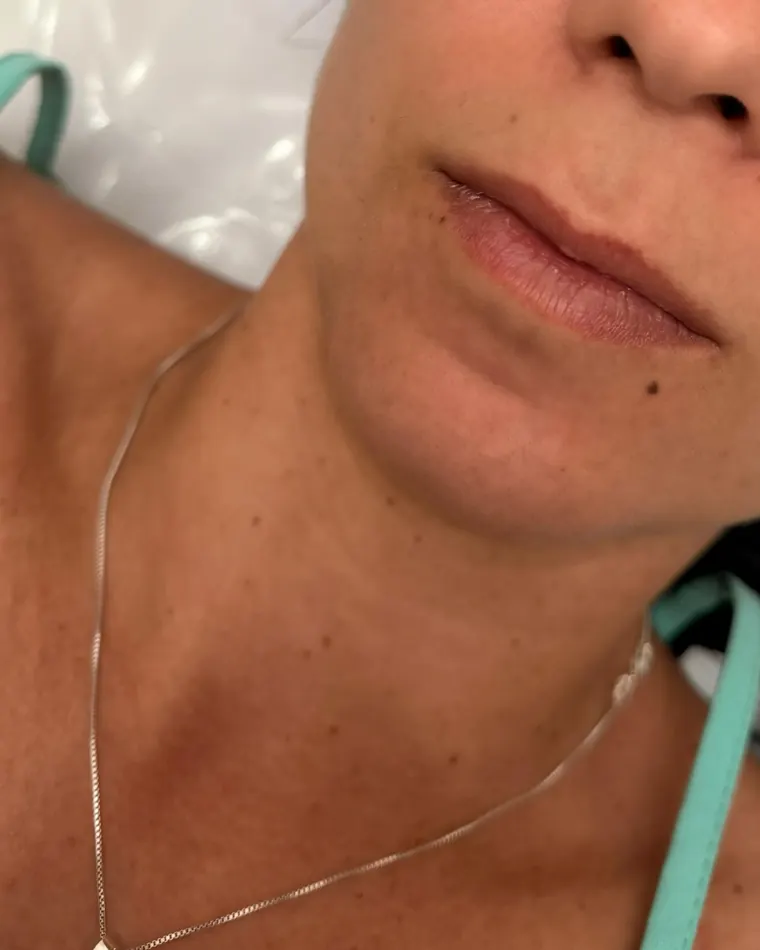 Boca pequena, primeira seringa: antes do procedimento