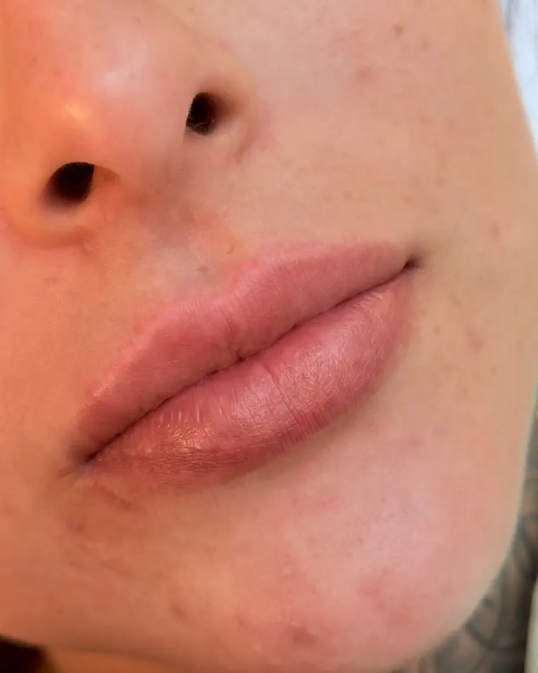RC Lips: antes do procedimento