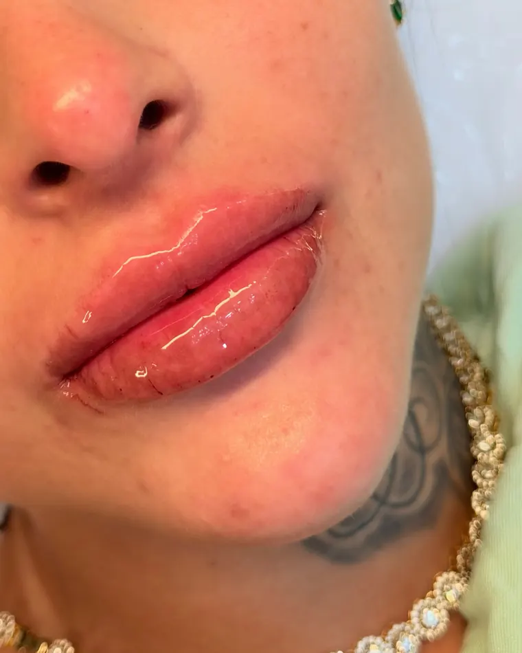 RC Lips: depois do procedimento