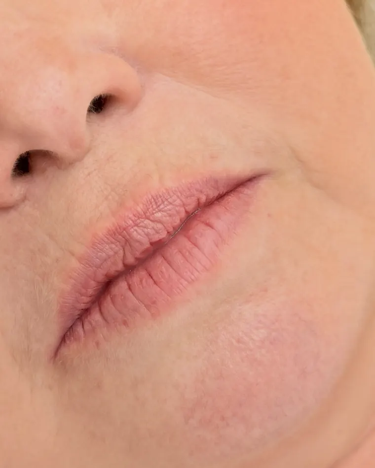 Rejuvenescimento labial: antes do procedimento