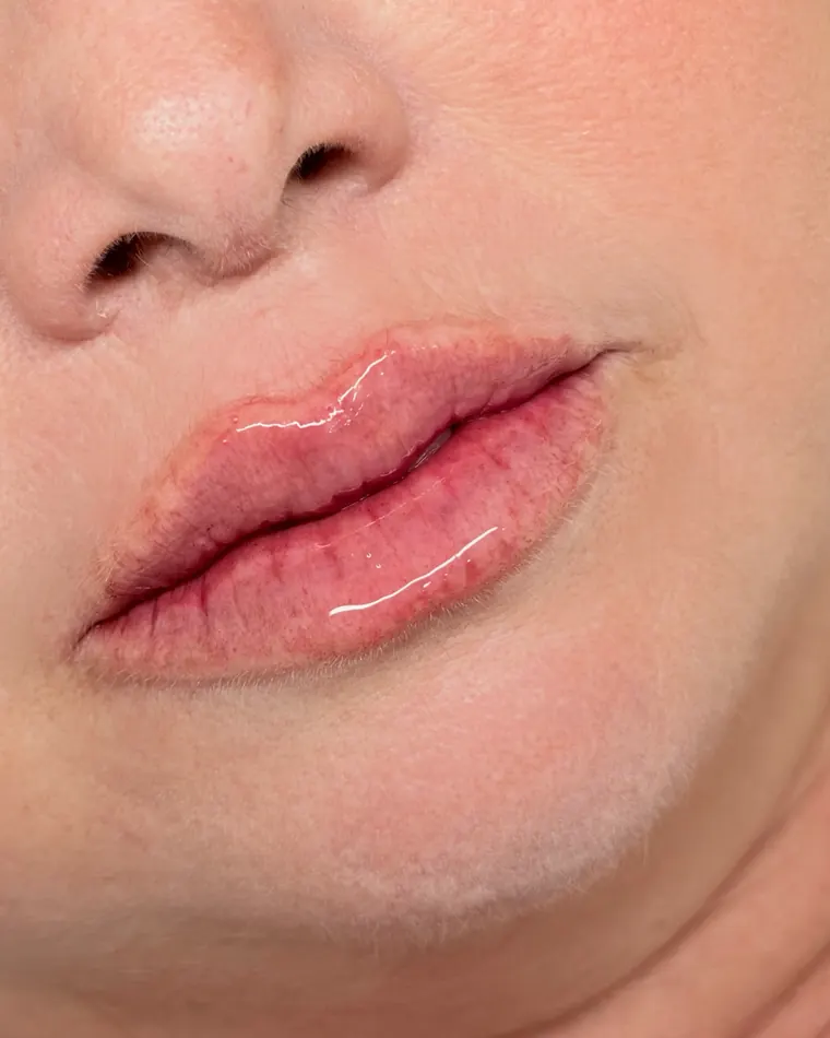 Rejuvenescimento labial: depois do procedimento