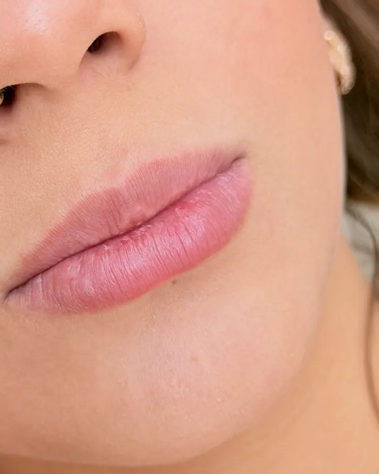 Mesma paciente: 1 ml