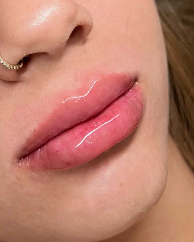 Mesma paciente: 2 ml