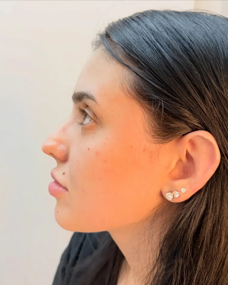 Perfil mais elegante: antes do procedimento