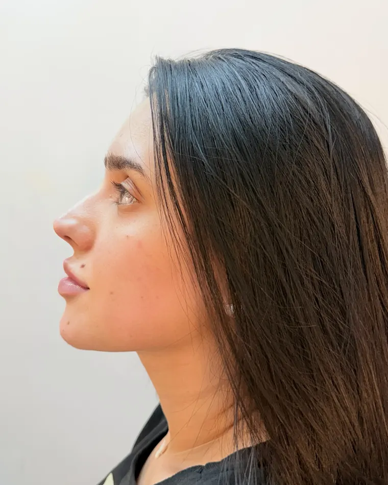 Perfil mais elegante: depois do procedimento
