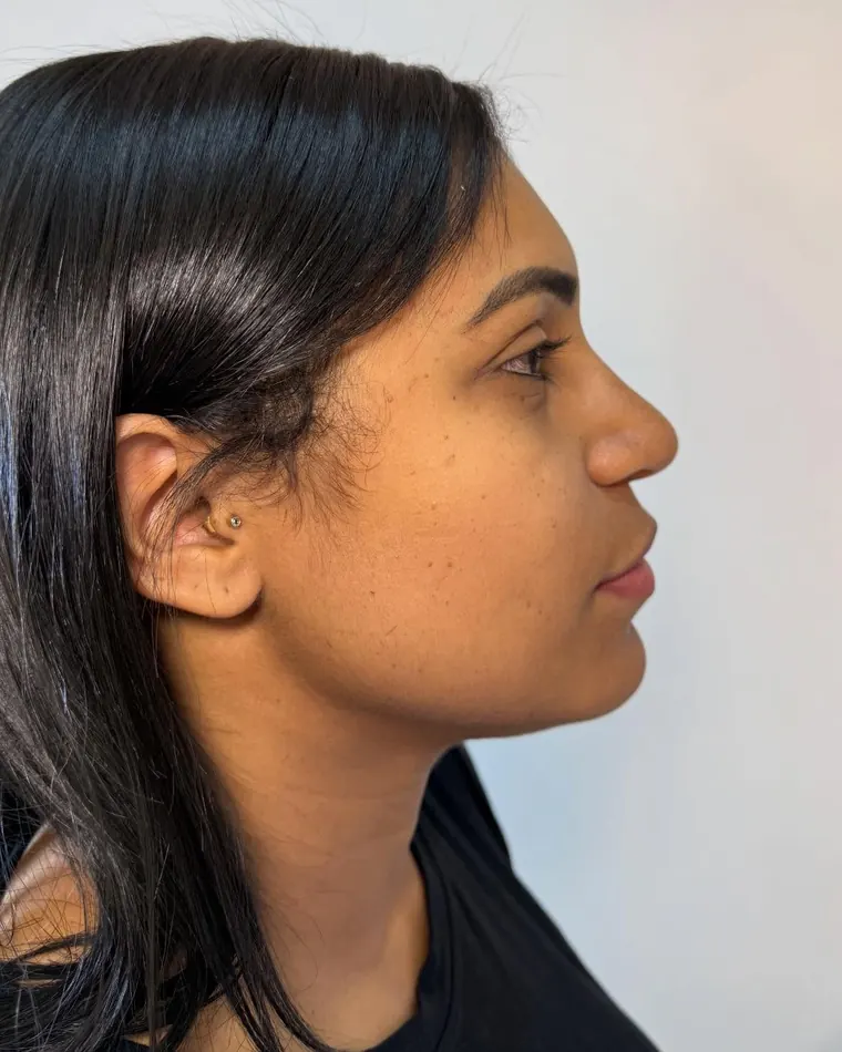 Perfil em harmonia: antes do procedimento