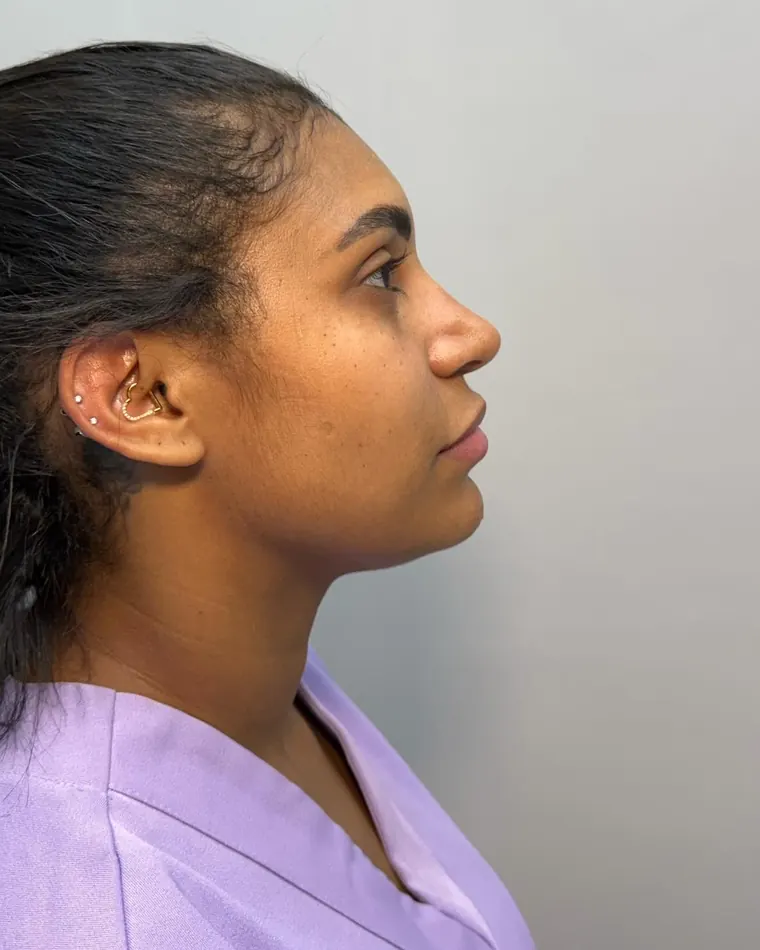 Perfil em harmonia: depois do procedimento