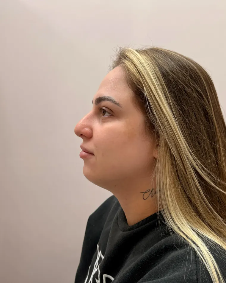 Queixo e boca: antes do procedimento