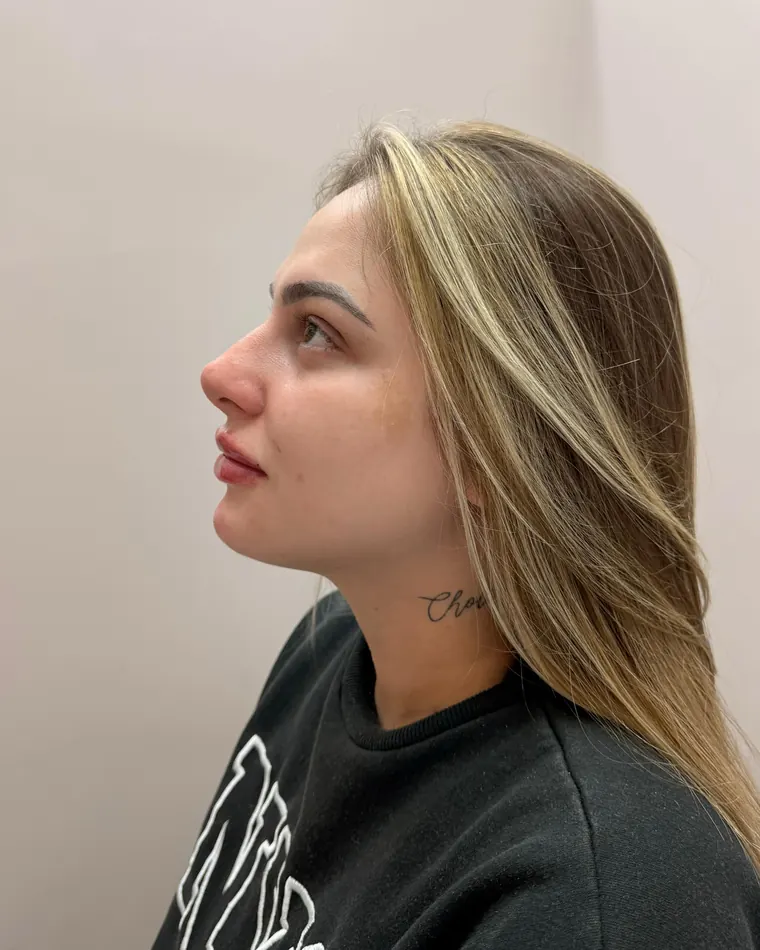 Queixo e boca: depois do procedimento